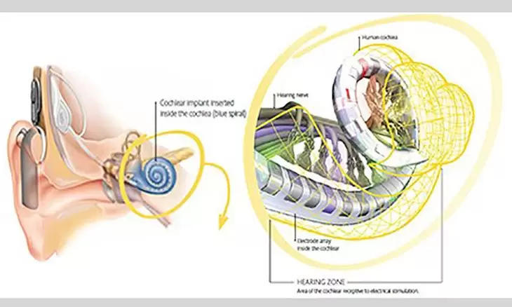 cochlear defarent