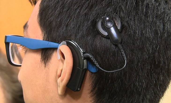 cochlear implant