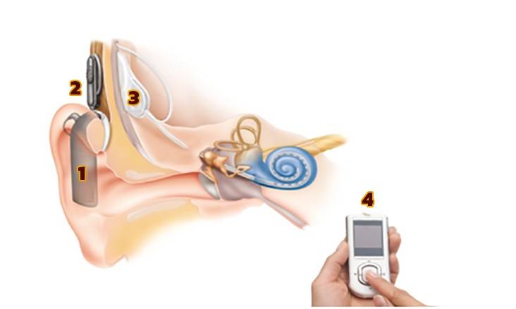ประสาทหูเทียม cochlear impant