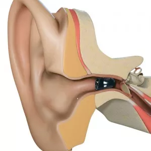 Tinnitus Masking Devices