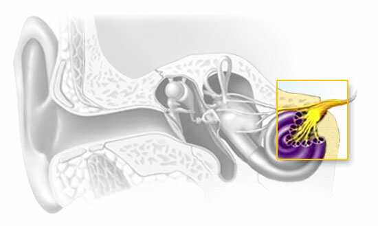 ประเภทที่มีความผิดปกติของกระแสประสาททางการได้ยิน (Auditory neuropathy spectrum disorder)